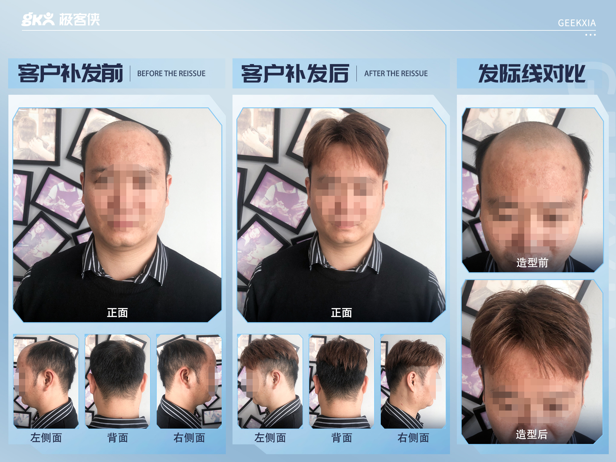 秃顶假发补发案例