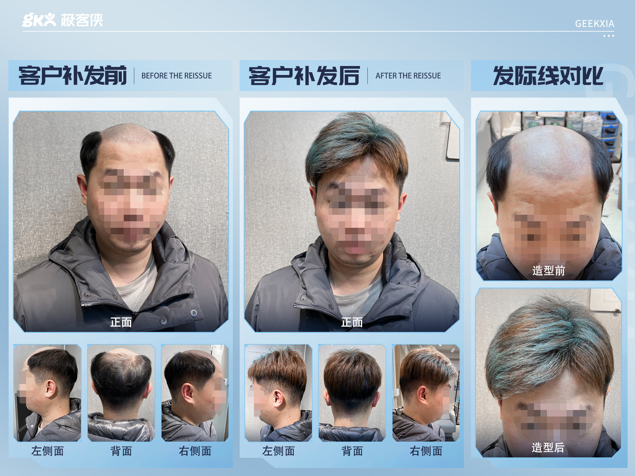 秃顶假发补发案例