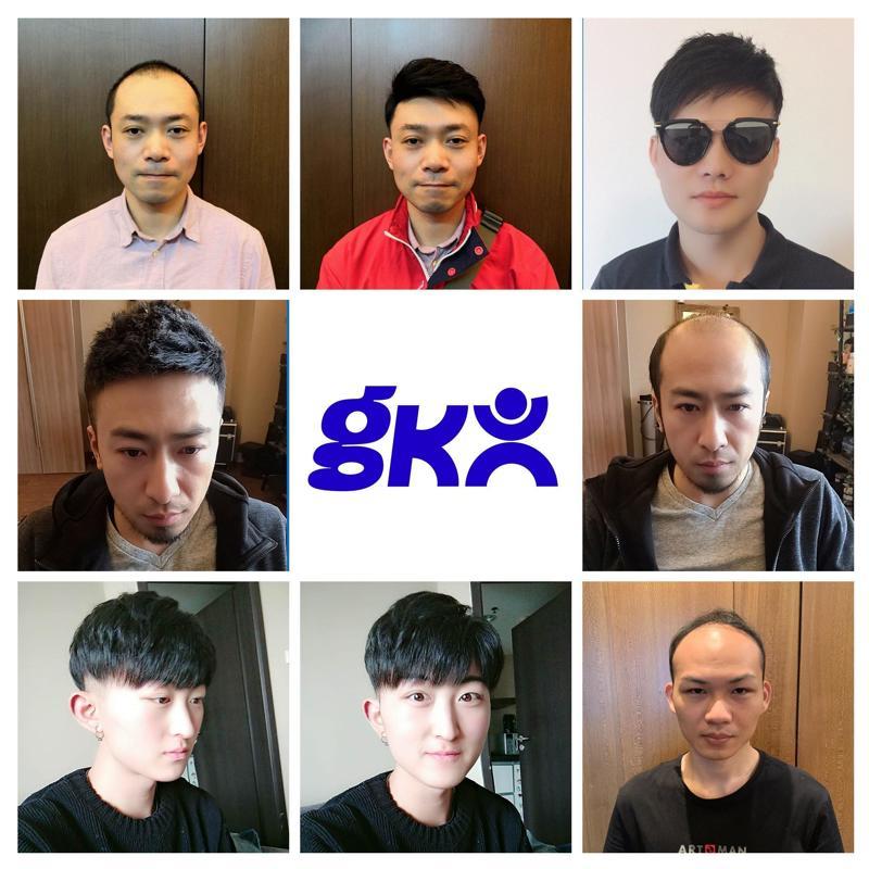 ✅脂溢性脱发怎么治疗